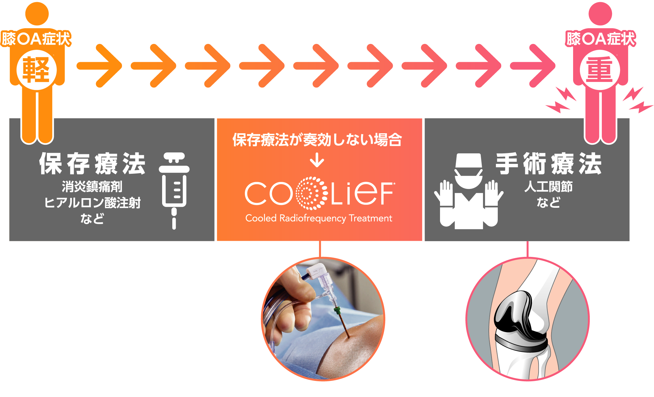 Coolief疼痛管理用高周波システムの説明図